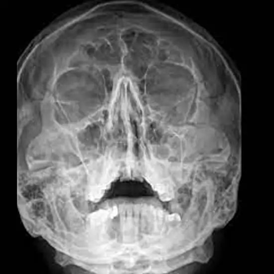 X-Ray Zygomatic Arch-Right